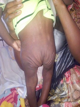 Eritrea drought, malnutrition and cholera